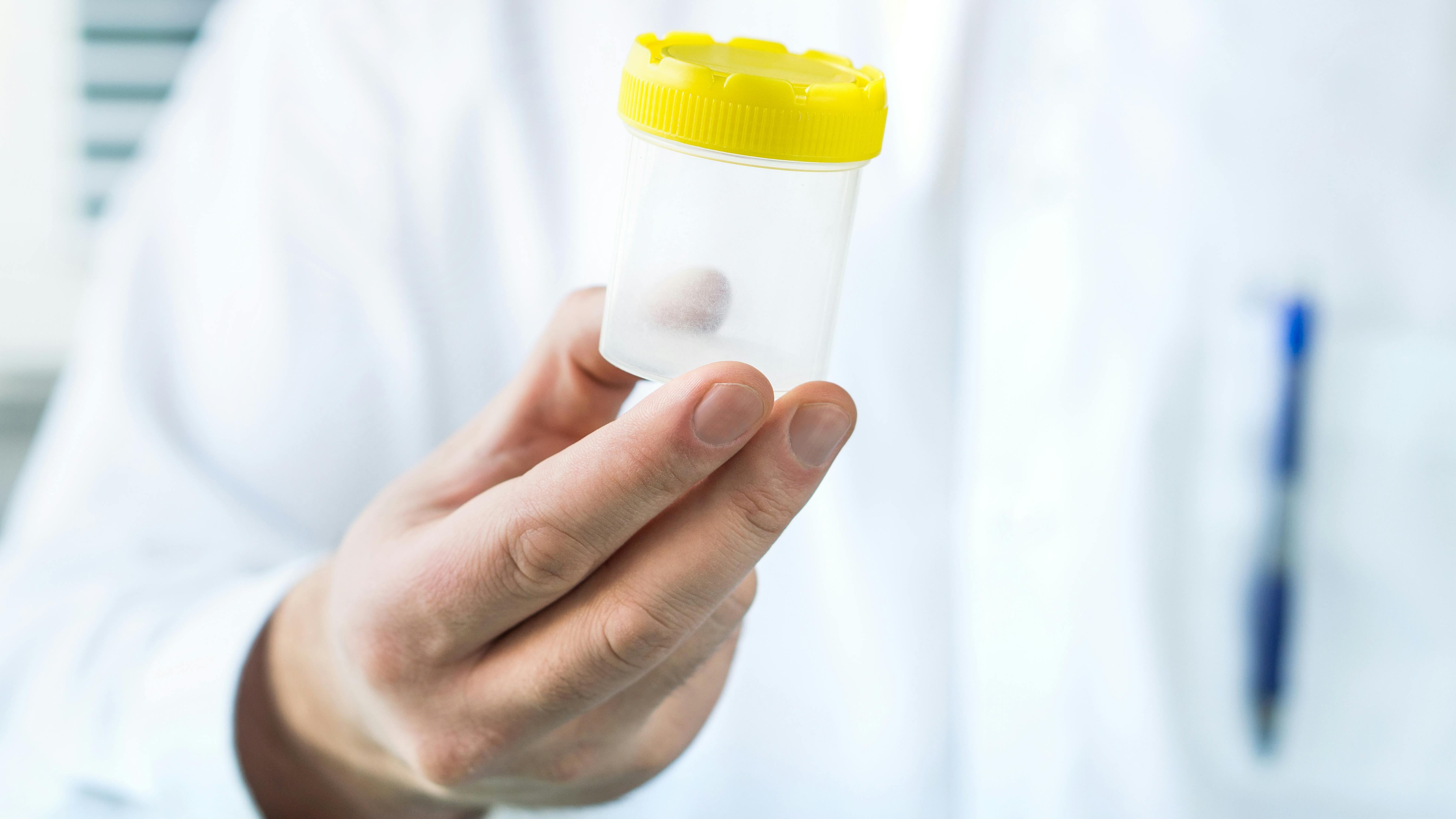 A person wearing a white lab coat holding an empty clear sample cup with a yellow lid
