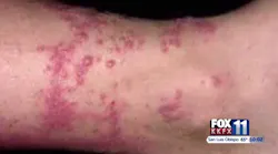 Santa Barbara County firefighter Danny Haynes suffered exposure to poison oak at two fires this summer. Santa Barbara County firefighter Danny Haynes suffered exposure to poison oak at two fires this summer.