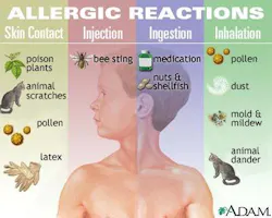 Allergy Pinterest 58f4ba1728b98 Allergy Pinterest 58f4ba1728b98