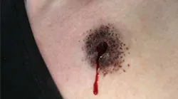 The effect of a bullet entry wound from the MasterCast line from Moulage Concepts Inc. The effect of a bullet entry wound from the MasterCast line from Moulage Concepts Inc.