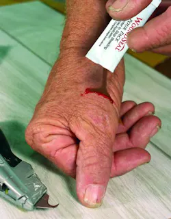 Contractingbusiness Com Sites Contractingbusiness com Files Uploads 2013 09 Wound Seal Stops Bleeding Instantly 0 Contractingbusiness Com Sites Contractingbusiness com Files Uploads 2013 09 Wound Seal Stops Bleeding Instantly 0