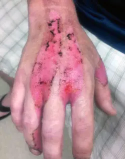 refrigerant burns hand refrigerant burns hand
