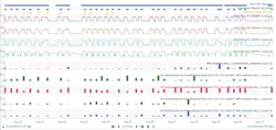 Figure 6: Multivariate pattern search analysis of four signals for each separation phase, with overall and individual dissimilarity values relative to best operation Figure 6: Multivariate pattern search analysis of four signals for each separation phase, with overall and individual dissimilarity values relative to best operation