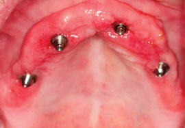 1404demas01 Inflamed Tissue