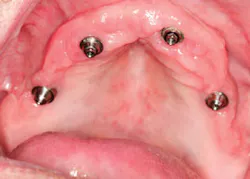 1404demas02 Healed Tissue 1404demas02 Healed Tissue