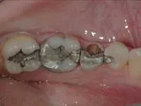 Figure 1: Premolar tooth with minimal tooth structure remaining requires a post and pins to ensure connection of the coronal build-up to the remaining root structure. Figure 1: Premolar tooth with minimal tooth structure remaining requires a post and pins to ensure connection of the coronal build-up to the remaining root structure.
