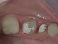 Figure 2: A fiber-reinforced resin-based composite post and two pure titanium pins (Filpins) have been placed in the premolar shown in Fig. 1 to ensure retention of the build-up material. Figure 2: A fiber-reinforced resin-based composite post and two pure titanium pins (Filpins) have been placed in the premolar shown in Fig. 1 to ensure retention of the build-up material.