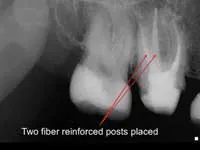 Figure 4: Tooth shown in figure 3 was built up with two fiber-reinforced resin-based composite posts and bonded composite. Figure 4: Tooth shown in figure 3 was built up with two fiber-reinforced resin-based composite posts and bonded composite.
