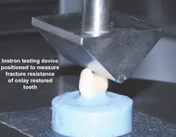 Figure 4: Tooth buildups were placed and retentive tooth preparations made. Figure 4: Tooth buildups were placed and retentive tooth preparations made.