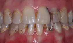Figure 6: IPS e.max (lithium disilicate) continues to grow for use in both posterior and anterior single-unit locations. It is serving well in those situations. Figure 6: IPS e.max (lithium disilicate) continues to grow for use in both posterior and anterior single-unit locations. It is serving well in those situations.