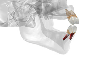 byAugust de Oliveira, DDS, andRyan C. Maher, DMD, FICOI