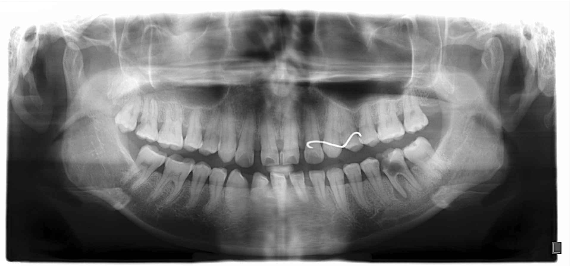 Xraywdeepcariesandlesion