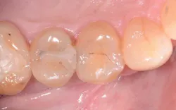 Obr 01 Pre Op scale ivoclar png Obr 01 Pre Op scale ivoclar png