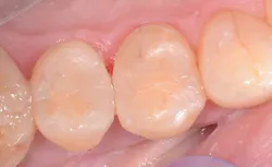 Obr 03 Final scale Ivoclar png Obr 03 Final scale Ivoclar png