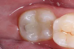 Ivoclar June Art3 Fig1 Ivoclar June Art3 Fig1