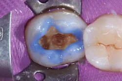 Ivoclar June Art3 Fig2 Ivoclar June Art3 Fig2