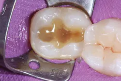 Ivoclar June Art3 Fig4 Ivoclar June Art3 Fig4