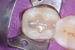 Ivoclar June Art3 Fig5 Ivoclar June Art3 Fig5