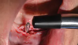 Content Dam De En Articles Print Volume 107 Issue 12 Science Tech Implant Stability Prior To Loading Implant Overdentures Leftcolumn Article Thumbnailimage File Content Dam De En Articles Print Volume 107 Issue 12 Science Tech Implant Stability Prior To Loading Implant Overdentures Leftcolumn Article Thumbnailimage File