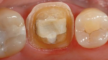 Content Dam De En Articles Print Volume 107 Issue 1 Science Tech A Dynamic Duo Maximizing Workflow And Clinical Success With Celtra Duo Calibra Ceram And Prime Bond Elect Leftcolumn Article Thumbnailimage File