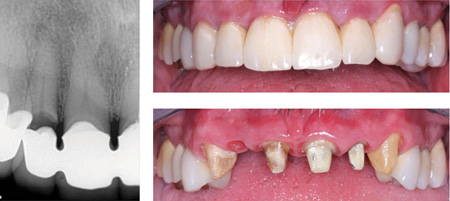 Content Dam De En Articles Print Volume 108 Issue 2 Science Tech Ask Dr Christensen What Material Should I Use For An Anterior Three Unit Fixed Prosthesis Leftcolumn Article Thumbnailimage File