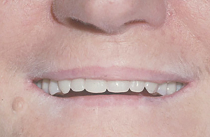 Content Dam De En Articles Print Volume 108 Issue 3 Science Tech If And When Should Vertical Dimension Of Occlusion Be Increased Leftcolumn Article Thumbnailimage File