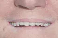 Content Dam De En Articles Print Volume 108 Issue 3 Science Tech If And When Should Vertical Dimension Of Occlusion Be Increased Leftcolumn Article Thumbnailimage File Content Dam De En Articles Print Volume 108 Issue 3 Science Tech If And When Should Vertical Dimension Of Occlusion Be Increased Leftcolumn Article Thumbnailimage File