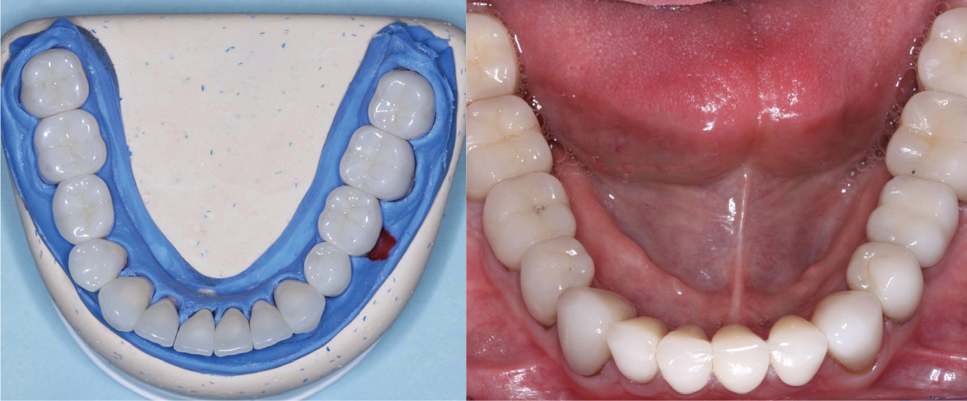 Figures 1 and 2: The restorations on the molars are Class 5 zirconia colored in the presintered stage, nonglazed or superficially stained. They are polished only. The restorations cannot be differentiated from the lithium disilicate restorations on the remainder of the teeth and implants. Note the lack of simulated caries on the occlusal surfaces, which is discouraged. Natural teeth without caries do not have occlusal color. Technicians: Jed and John Archibald; Archibald Associates; Orem, Utah. Clinician: Gordon Christensen, DDS, prosthodontist.