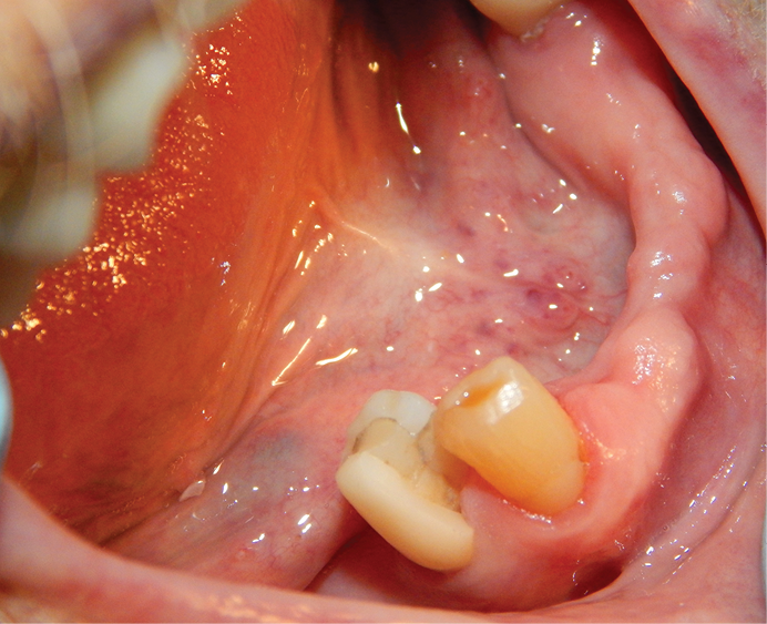 Figure 1: No. 28 crown that had fractured after root canal therapy was completed
