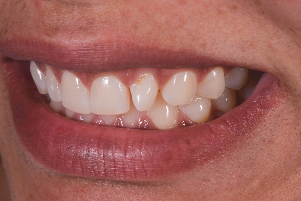 Figure 1: Lateral smile view