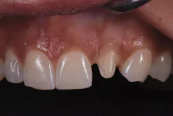 Figure 2: Lateral retracted view of prepped lateral incisor, No. 10 Figure 2: Lateral retracted view of prepped lateral incisor, No. 10