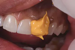 Figure 3: Application of Honigum Pro-Light Figure 3: Application of Honigum Pro-Light