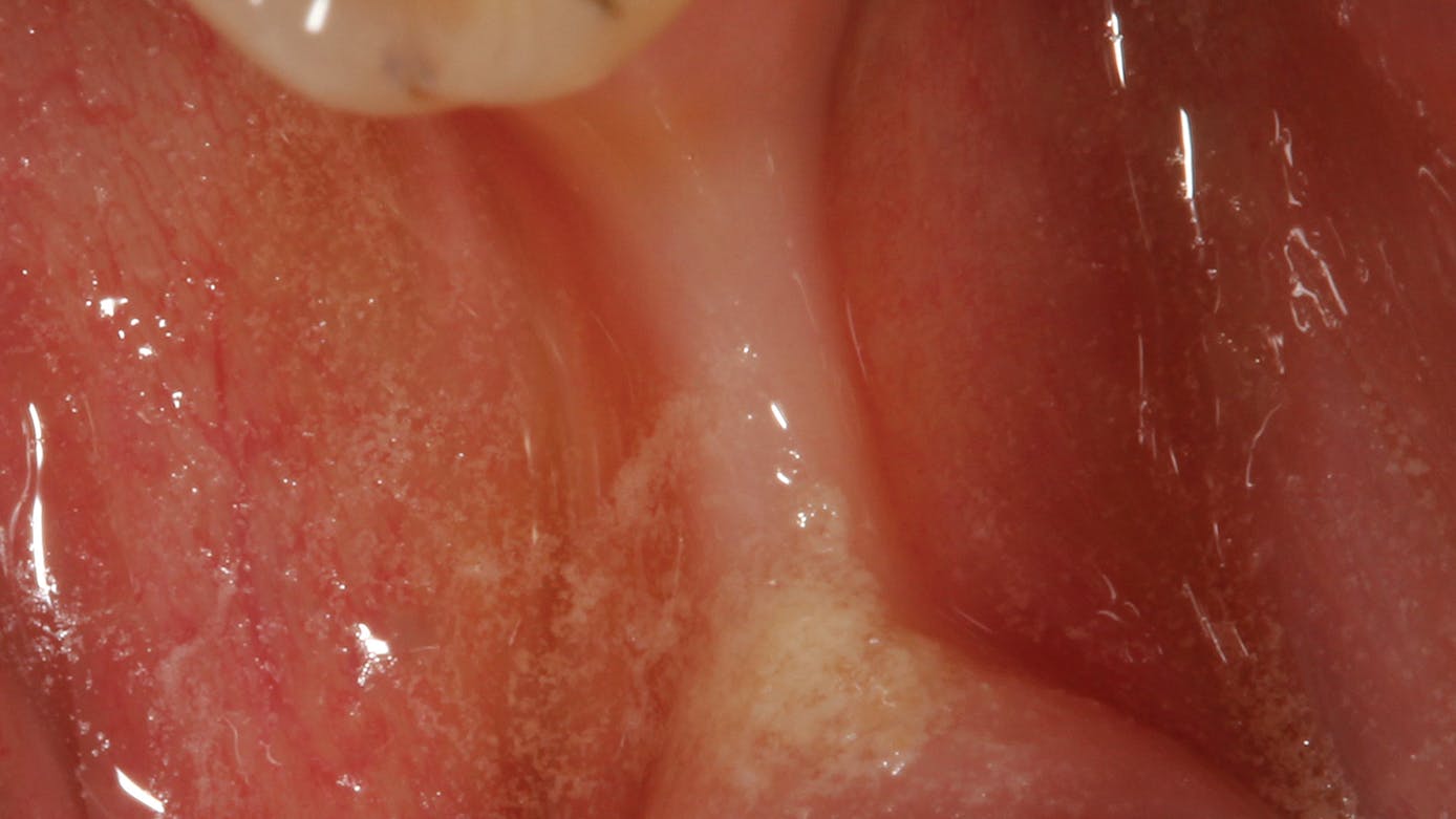 Figure 1: Site No. 29 was extracted one year prior to the photo, resulting in severe ridge resorption and the need for ridge augmentation prior to dental implant treatment.