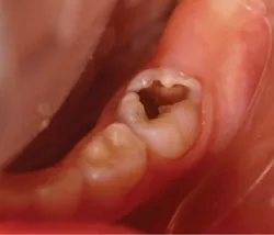 Figure 1: A preoperative photograph of occlusal caries in a left mandibular primary second molar Figure 1: A preoperative photograph of occlusal caries in a left mandibular primary second molar