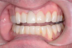 Figure 4: After: Crown milled in-house using CS 3700, CS ScanFlow, and smart shade matching Figure 4: After: Crown milled in-house using CS 3700, CS ScanFlow, and smart shade matching