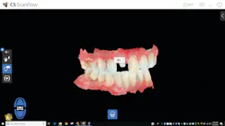 Figure 3: Core shade identified by CS ScanFlow Figure 3: Core shade identified by CS ScanFlow