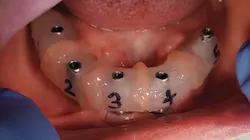 Figure 9: Luting the verification jigs in place in the mouth Figure 9: Luting the verification jigs in place in the mouth