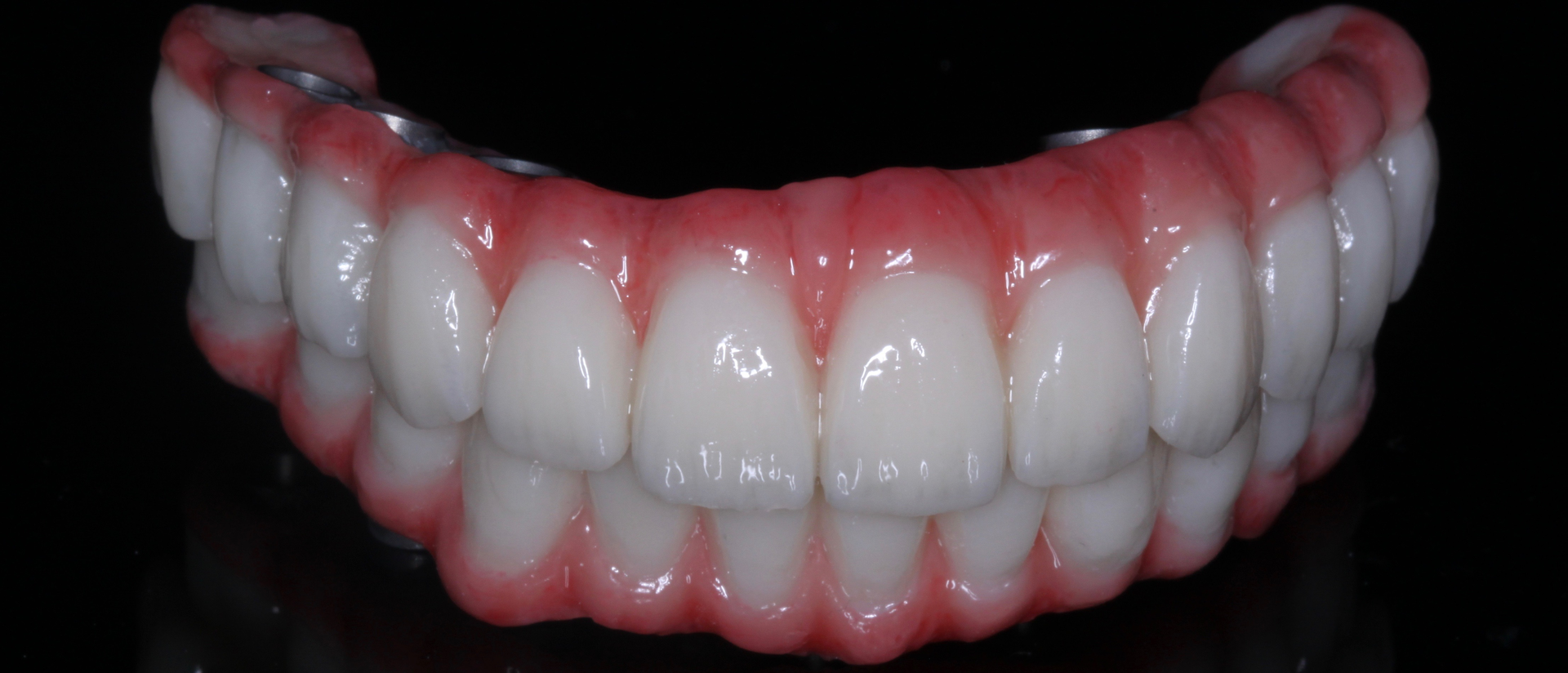 Figure 1: All-digital 3-D printed hybrid from a Trios (3Shape) scan