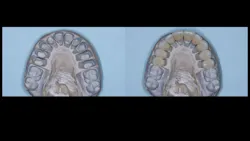 Figure 2: Dies of tooth preparations designed to eliminate orthodontic malpositioning and IPS e.max lithium disilicate single crowns (class 3 ceramic restorations) Figure 2: Dies of tooth preparations designed to eliminate orthodontic malpositioning and IPS e.max lithium disilicate single crowns (class 3 ceramic restorations)