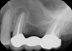 Figure 1: Pre-op x-ray Figure 1: Pre-op x-ray