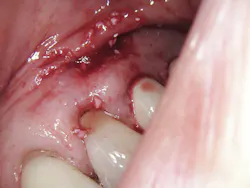 Figure 5: Immediately post-op Figure 5: Immediately post-op