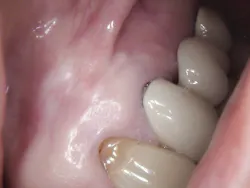 Figure 9: Soft tissue at eight months post-op Figure 9: Soft tissue at eight months post-op