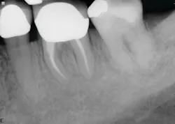 Figure 4: Six-month recall—case 2 Figure 4: Six-month recall—case 2