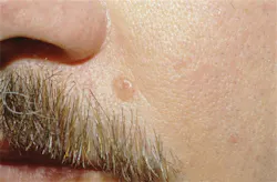 Figure 2: Basal cell carcinoma Figure 2: Basal cell carcinoma