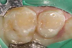 Figure 1: Preoperative isolated tooth A to be restored due to mesial caries Figure 1: Preoperative isolated tooth A to be restored due to mesial caries