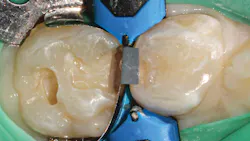 Figure 2: Conservative mesial-occlusal preparation on tooth A with Composi-Tight 3D XR matrix system Figure 2: Conservative mesial-occlusal preparation on tooth A with Composi-Tight 3D XR matrix system