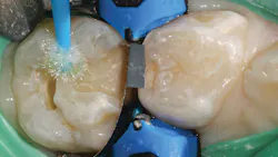 Figure 3: Application of Futurabond U Figure 3: Application of Futurabond U