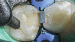 Figure 5: Filling with Admira Fusion x-tra Figure 5: Filling with Admira Fusion x-tra