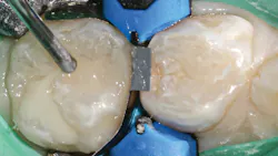 Figure 6: Topcoat of Admira Fusion x-base Figure 6: Topcoat of Admira Fusion x-base
