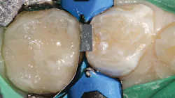 Figure 7: Immediate postoperative mesial-occlusal restoration Figure 7: Immediate postoperative mesial-occlusal restoration